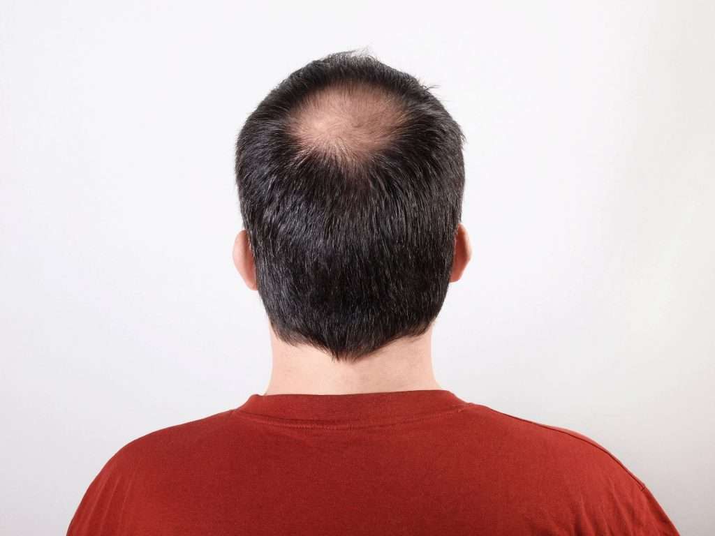 back of male head with thinning hair or alopecia o 2021 09 01 10 31 15 utc scaled 2