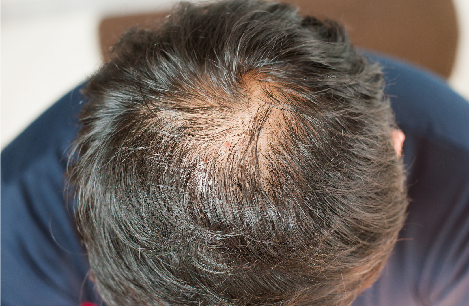 Scalp Acne Treatment in Singapore - Treating Scalp Acne Quickly and  Effectively