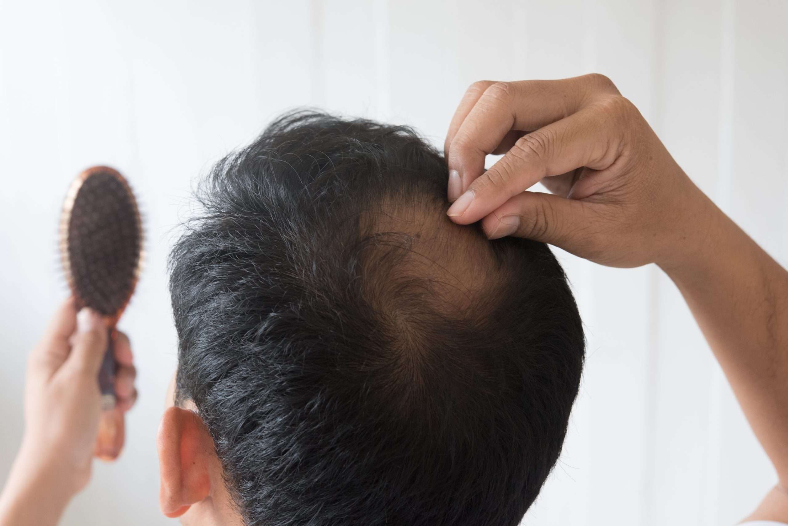men are worried about hair loss scaled